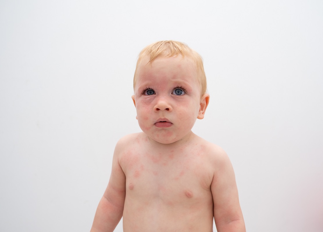Niño con dermatitis